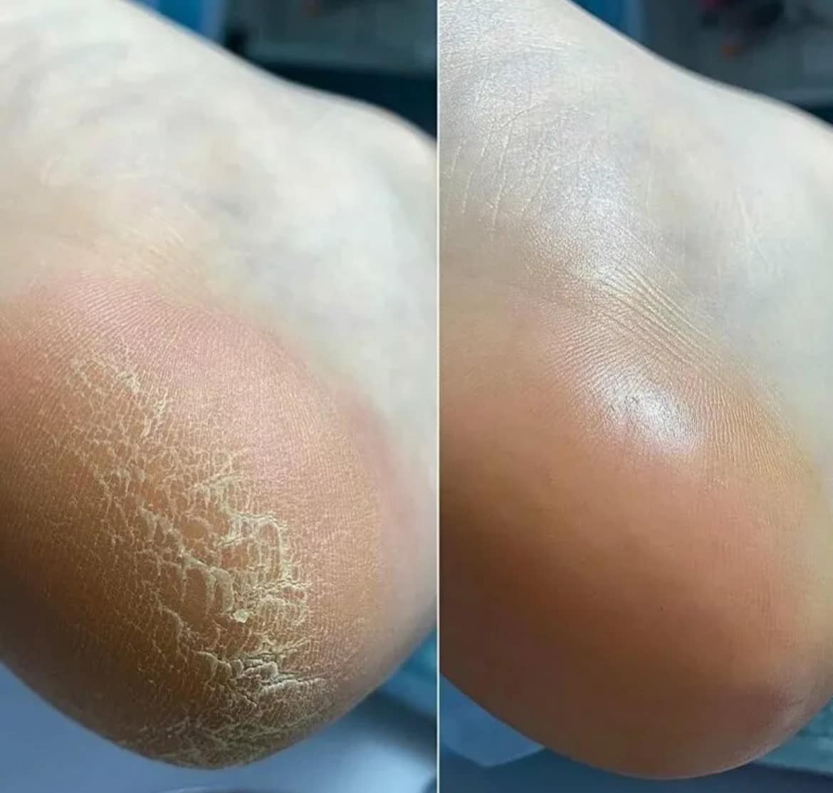 SMART Pedicure