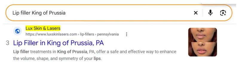 Google result 3: Lux Skin Lasers for Lip filler King of Prussia