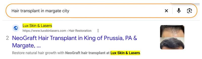 Google result 2: Lux Skin Lasers for Hair transplant in Margate City