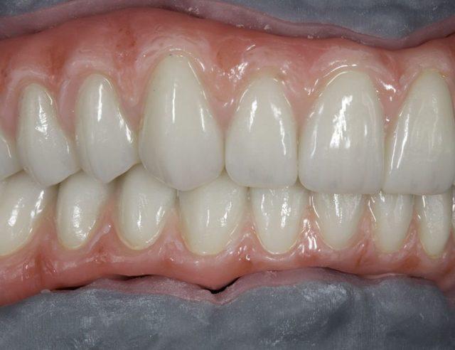 In the lab: Full-arch on implants, upper and lower