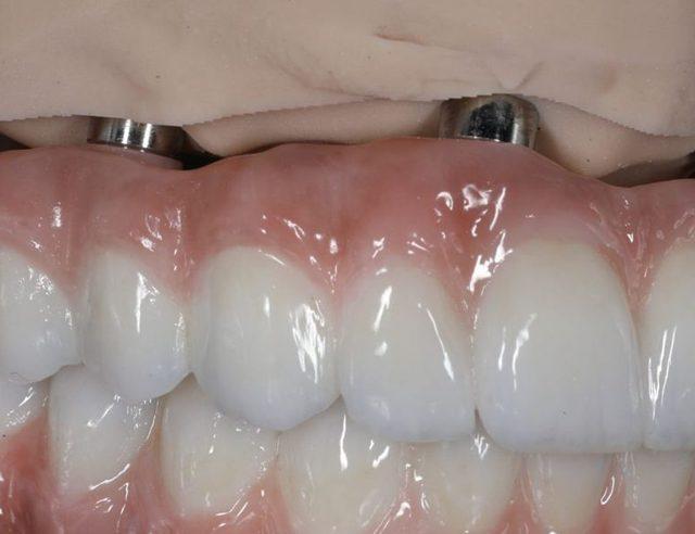 In the lab: Full-arch on implants, upper and lower