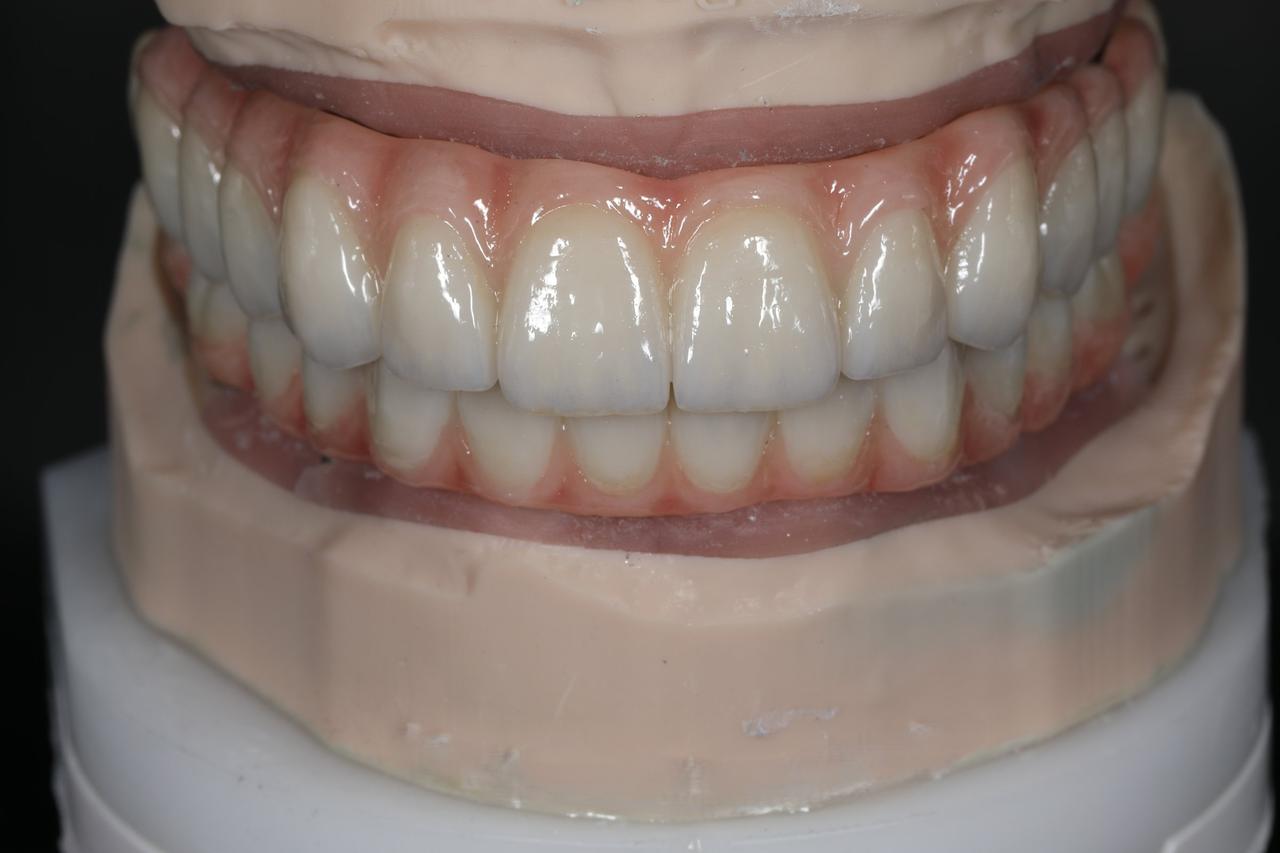All-on-X on a titanium bar with zirconia, upper and lower, on the model