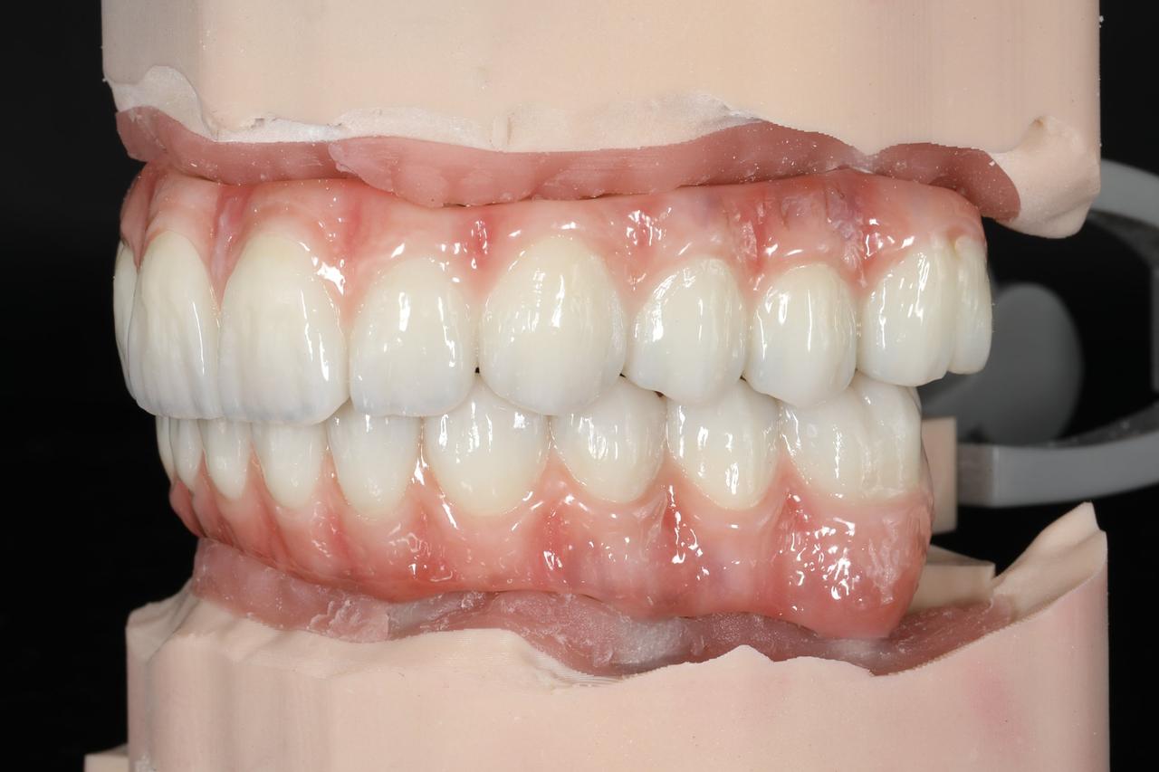 Zirconia full-arch, upper and lower, oblique view on the model