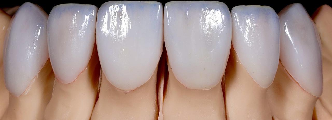Layered IPS e.max veneers, anterior six, by Grin Dental Lab San Francisco