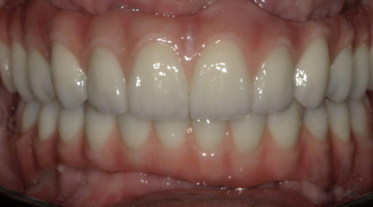Full-arch on implants, upper and lower, Grin Dental Lab