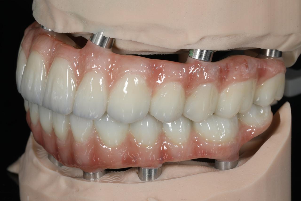 Zirconia full-arch with pink gingiva, side view on the model