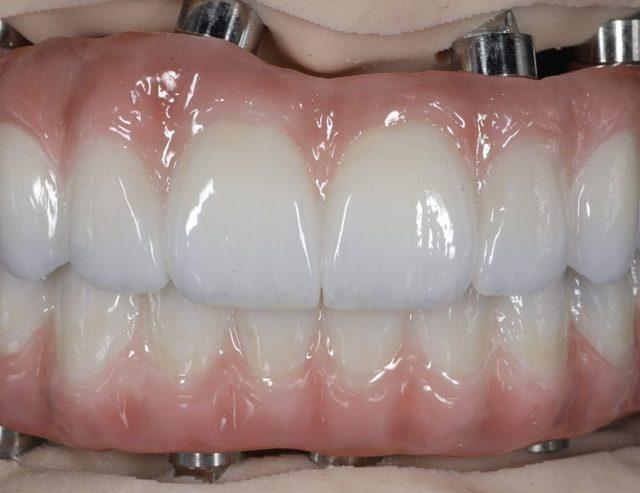 In the lab: Full-arch on implants, upper and lower