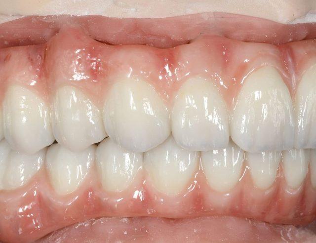 In the lab: Full-arch on implants, upper and lower