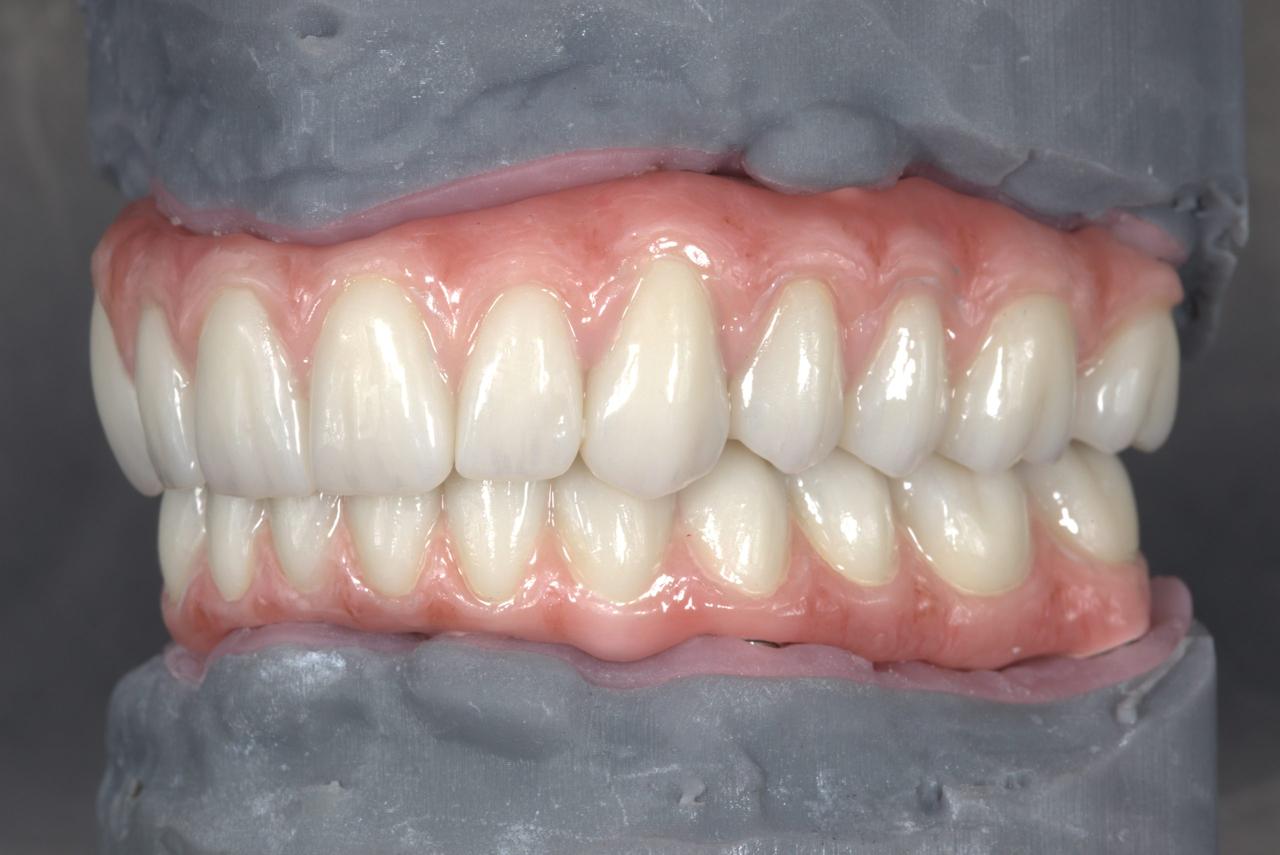 In the lab: Full-arch on implants, upper and lower