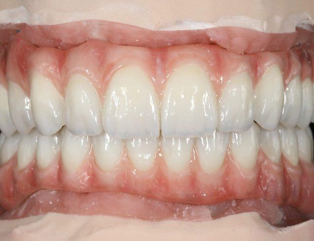 Full-arch on the plaster model, Grin Dental Lab