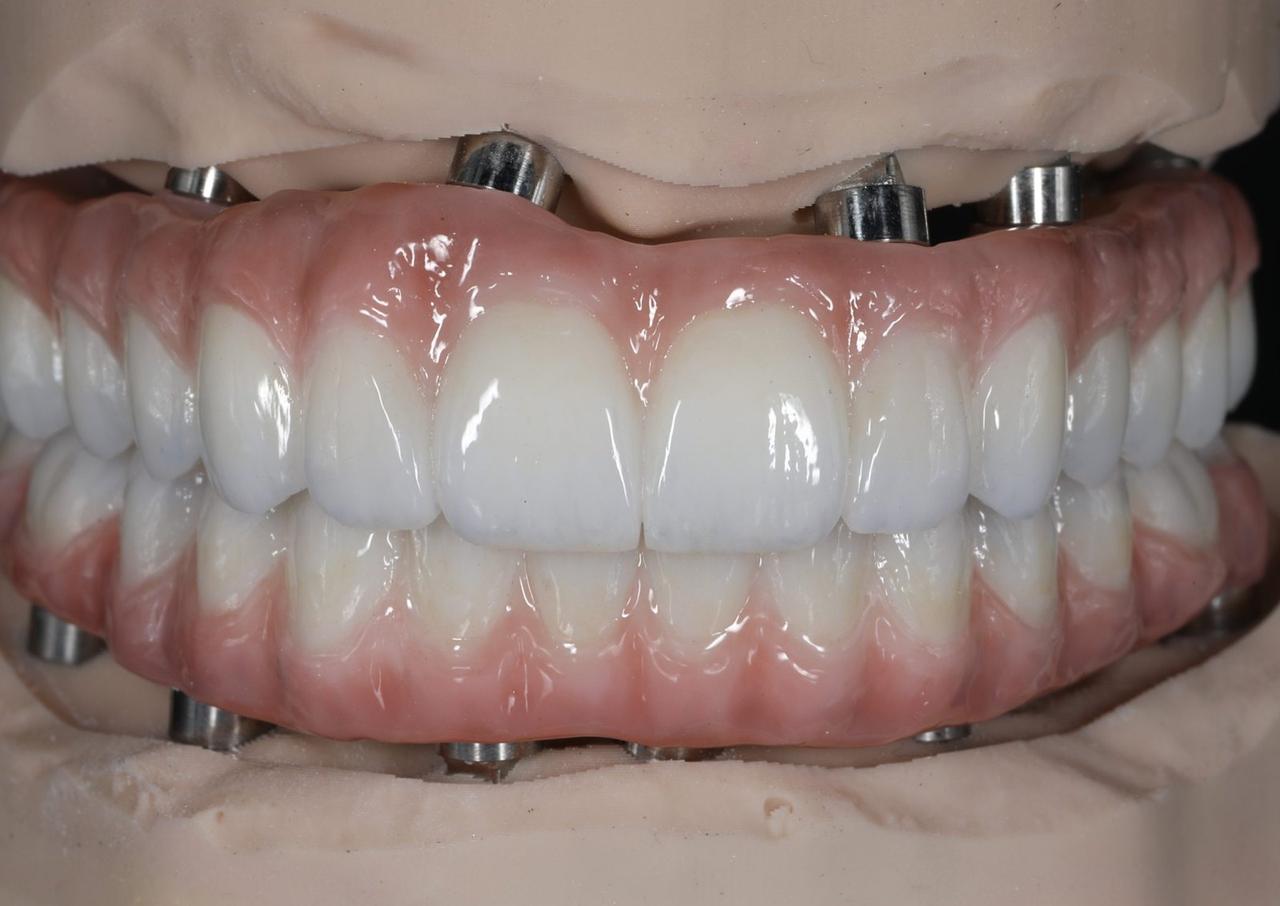 Monolithic zirconia full-arch prosthesis made by Grin Dental Lab, San Francisco