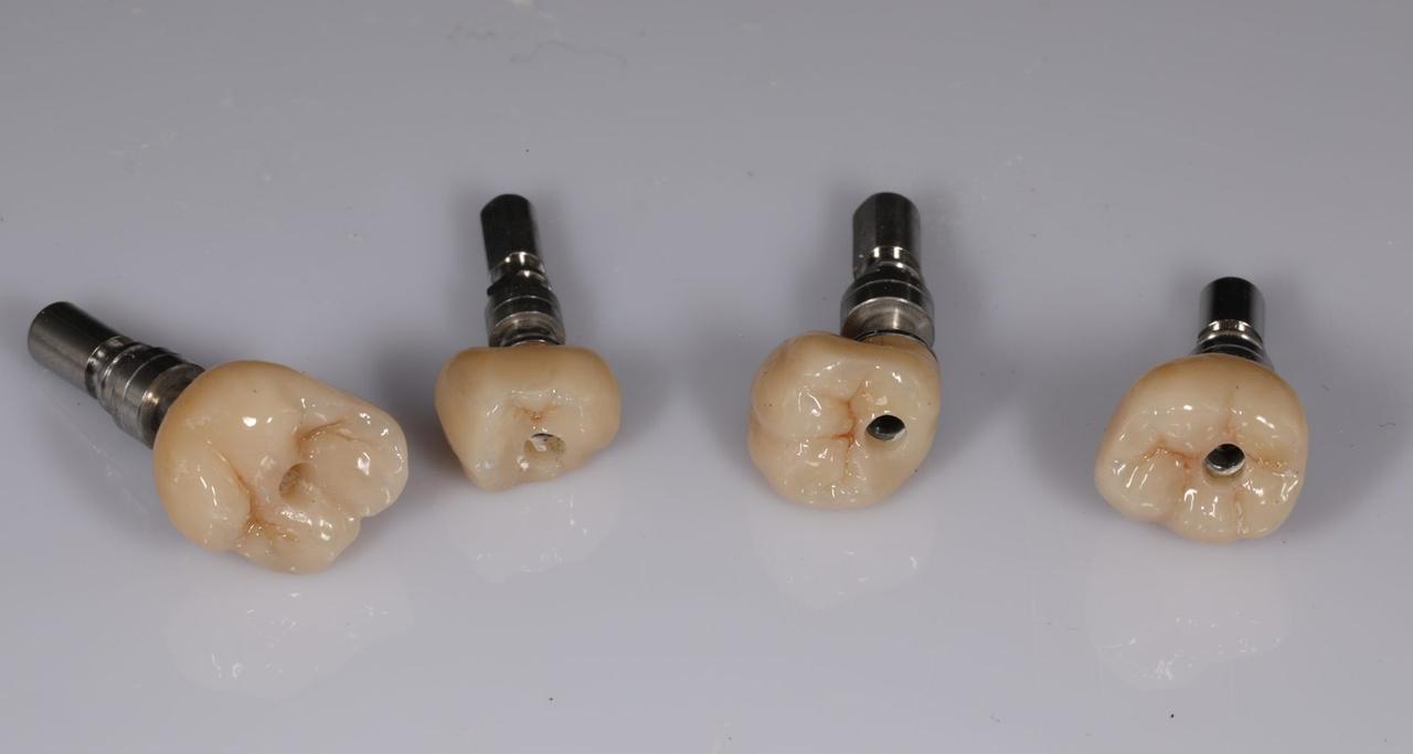 Screw-retained implant crowns made at Grin Dental Lab, San Francisco