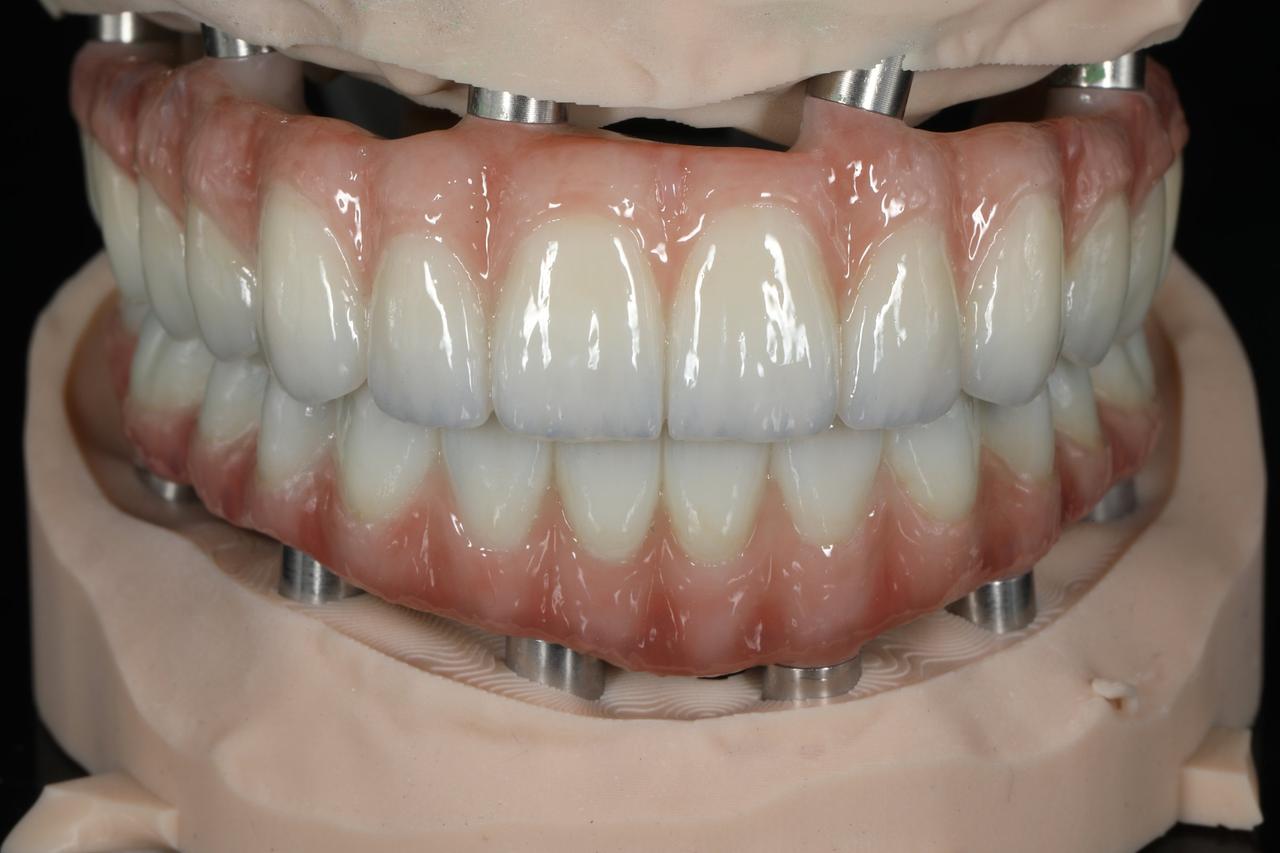 Zirconia full-arch on implants, upper and lower, on the model