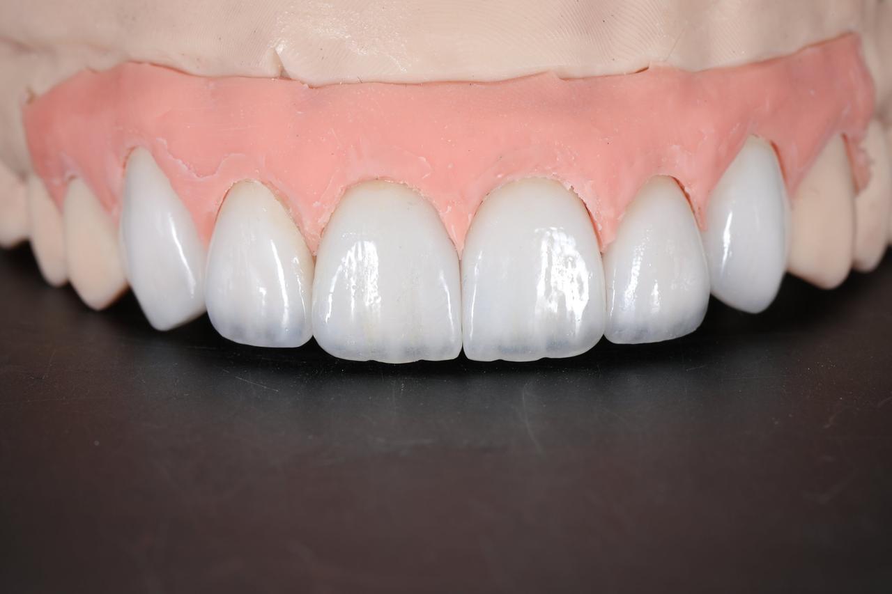 Porcelain veneers on the model