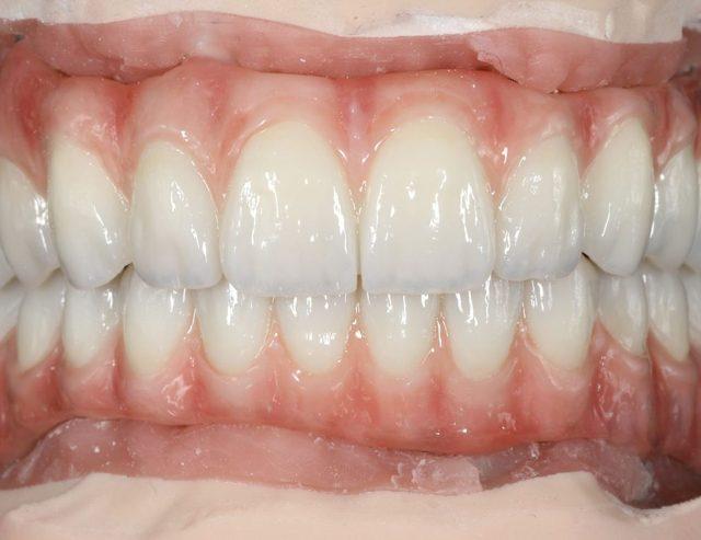 In the lab: Full-arch on implants, upper and lower