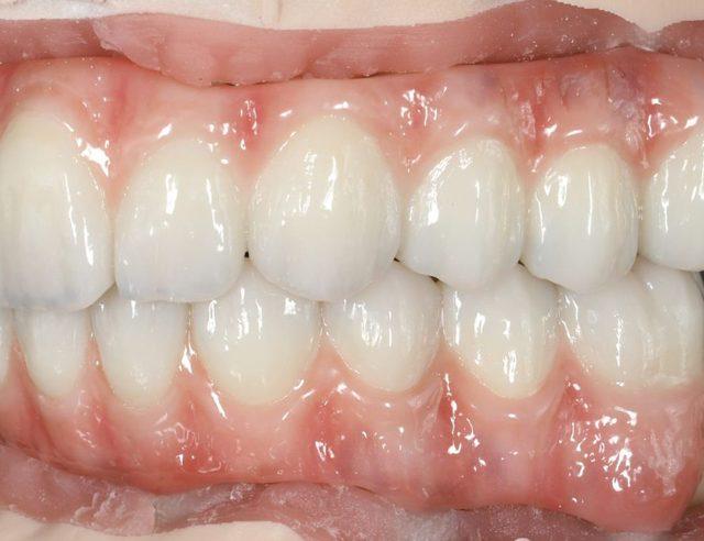 In the lab: Full-arch on implants, upper and lower