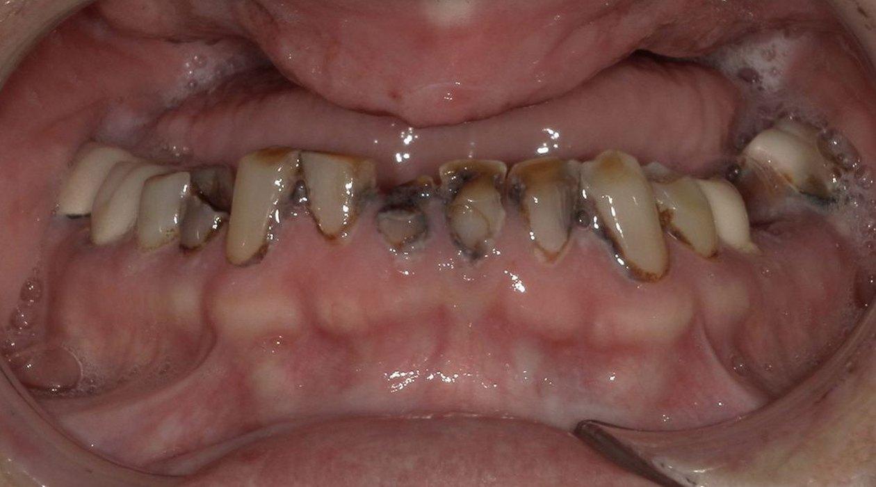 Before: Full-arch on implants, upper and lower