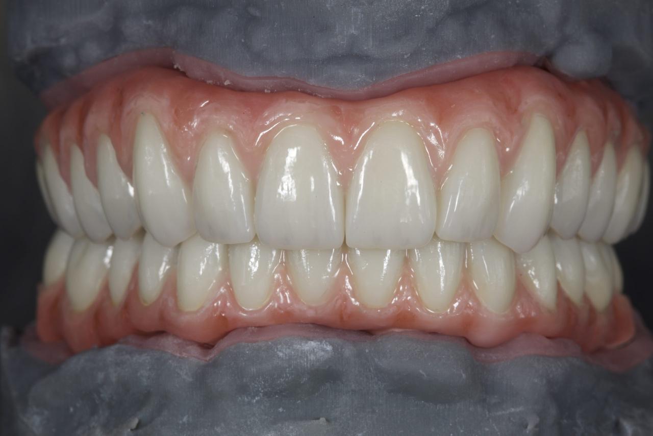 In the lab: Full-arch on implants, upper and lower