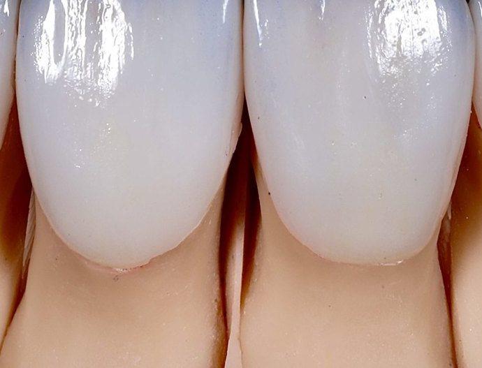 Veneers, anterior, Grin Dental Lab