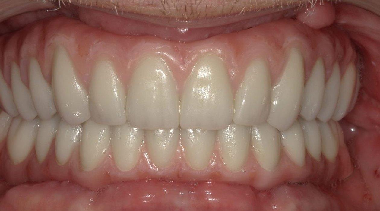 After: Full-arch on implants, upper and lower, Grin Dental Lab