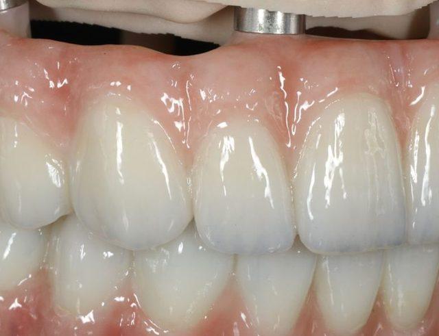In the lab: Full-arch on implants, upper and lower