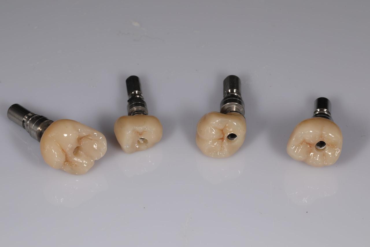 Implant crowns, Grin Dental Lab