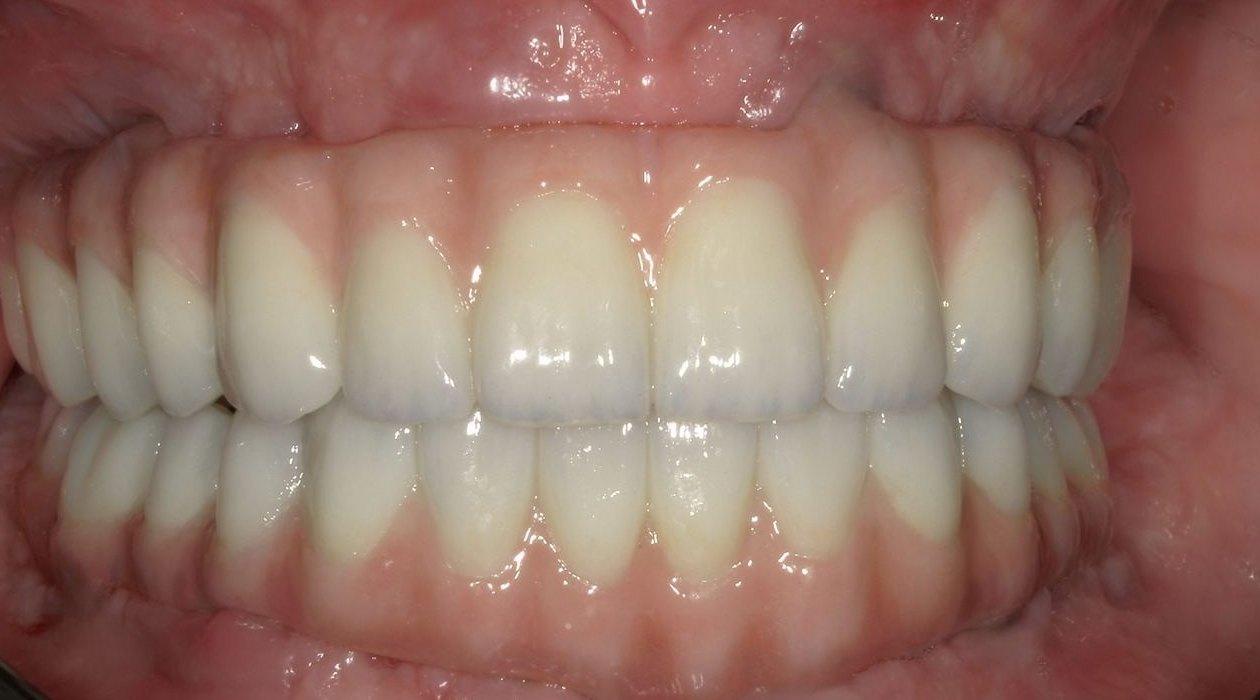 Full-arch on implants, upper and lower, Grin Dental Lab