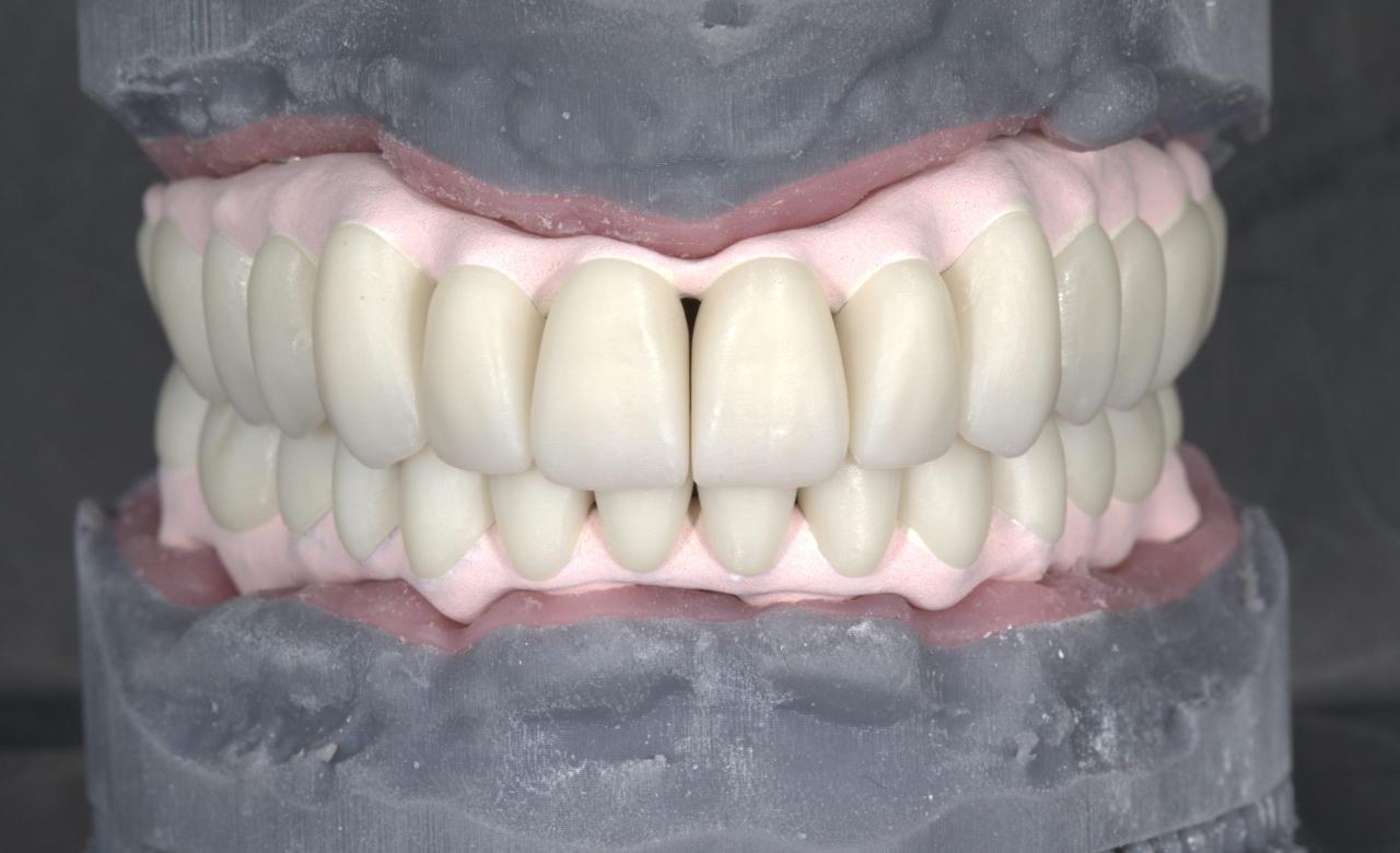In the lab: Full-arch on implants, upper and lower