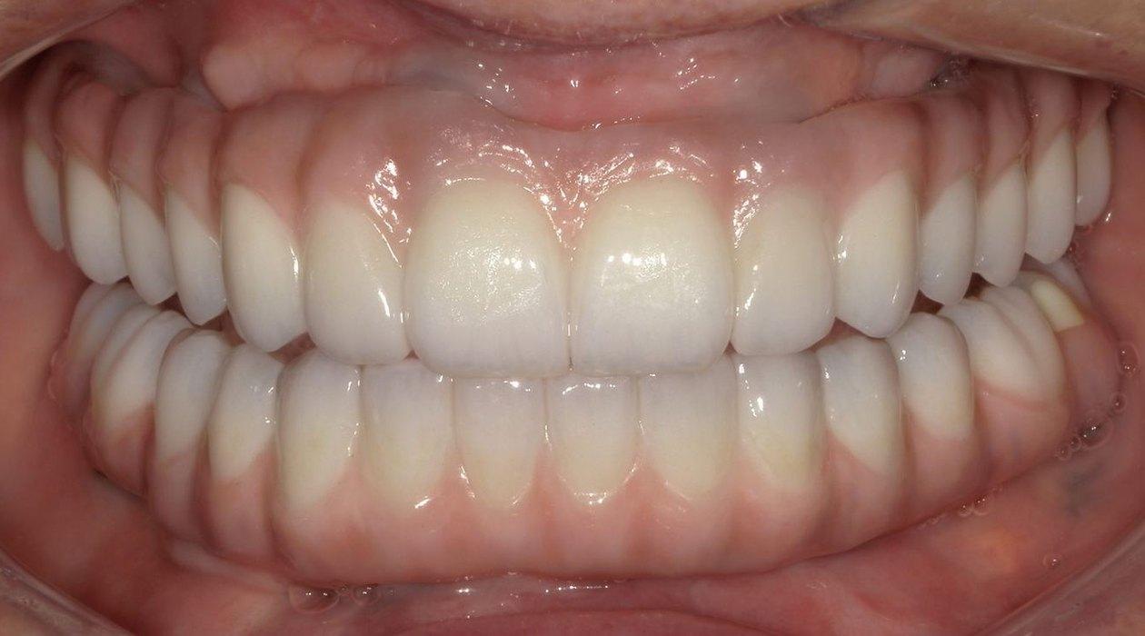 After: Full-arch on implants, upper and lower, Grin Dental Lab