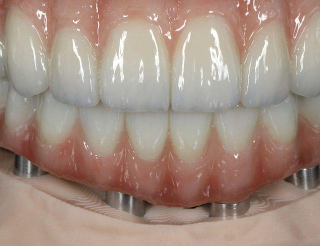 In the lab: Full-arch on implants, upper and lower