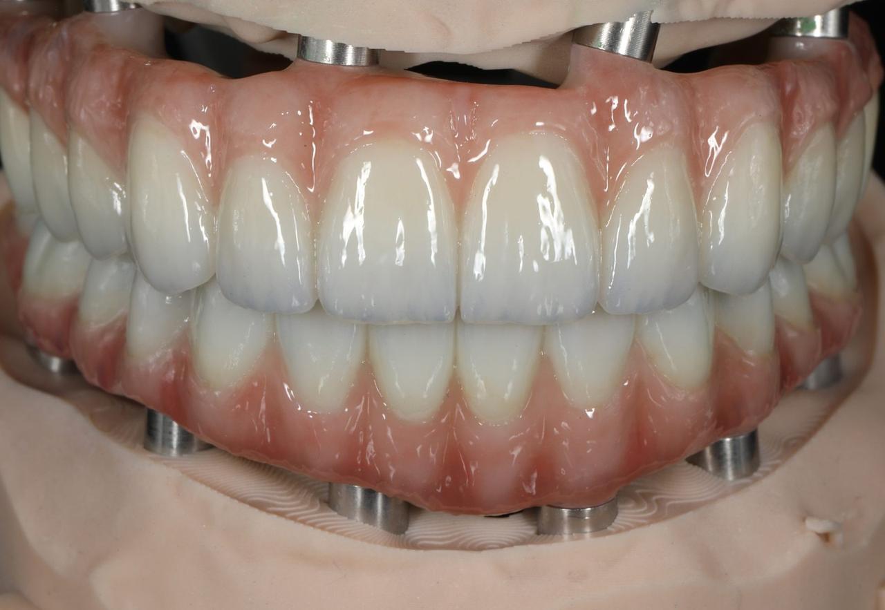 Upper and lower zirconia full-arch prostheses on implant analogs, Grin Dental Lab