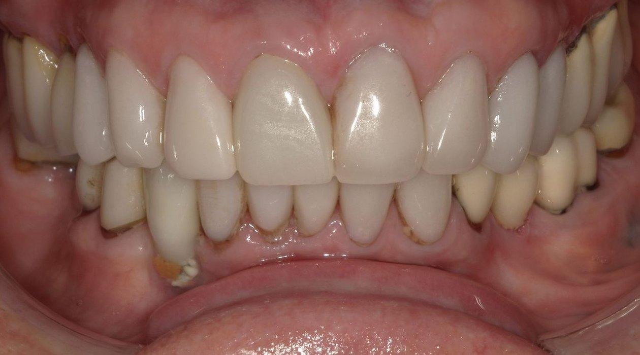 Before: Full-arch on implants, upper and lower