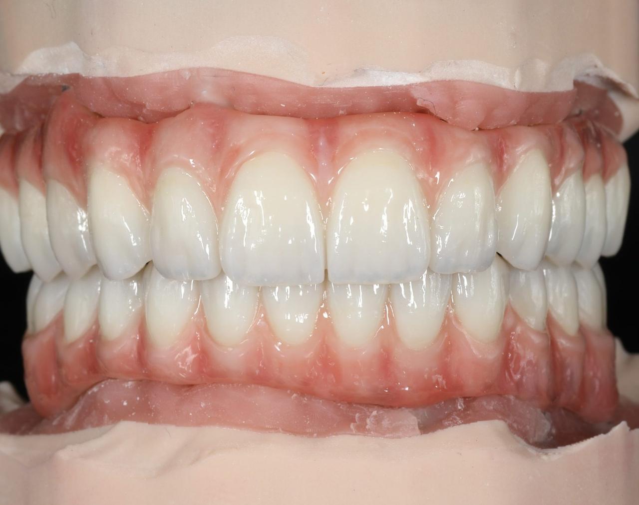 Full-arch zirconia upper and lower in occlusion on a plaster model, made by Grin Dental Lab in San Francisco