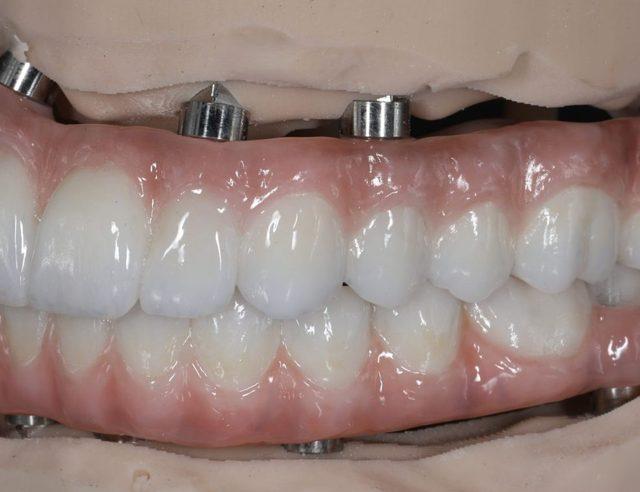 In the lab: Full-arch on implants, upper and lower